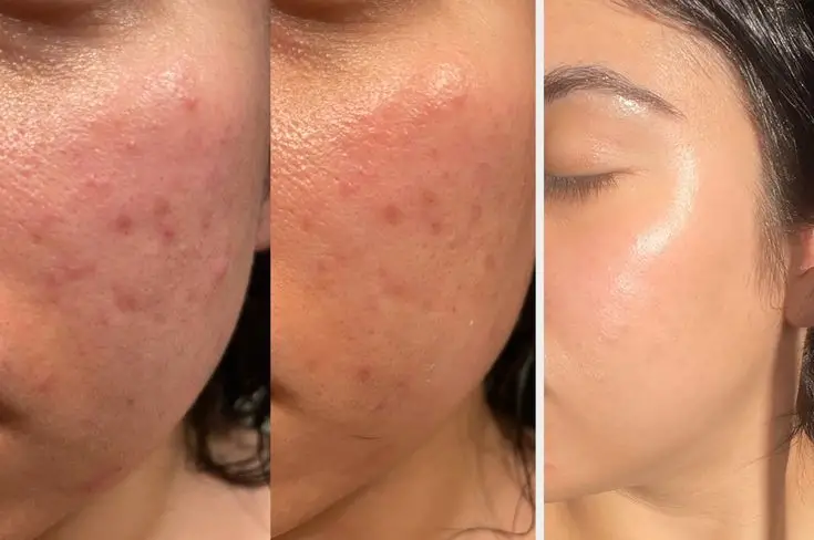 عکس قبل و بعد پاکسازی صورت سبزه رنگ