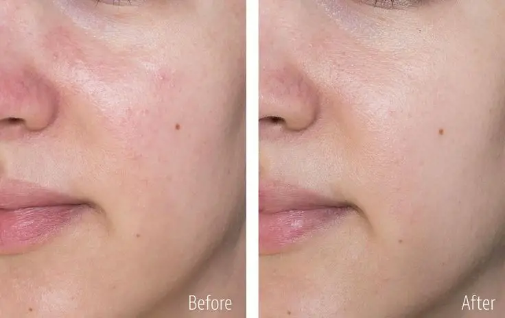 عکس قبل و بعد پاکسازی صورت سفید پوست روشن